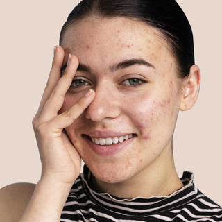 Oily & Acne Prone Skin